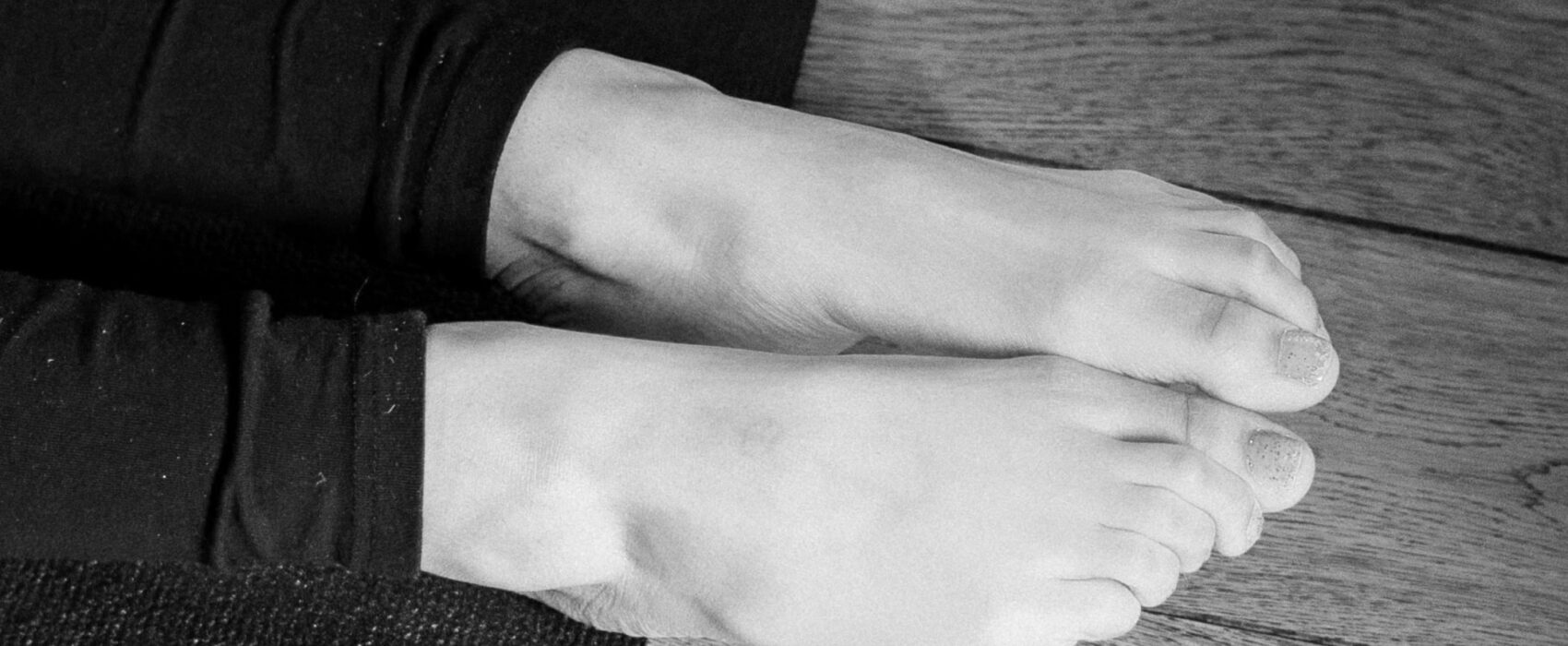 Neuroma di Morton